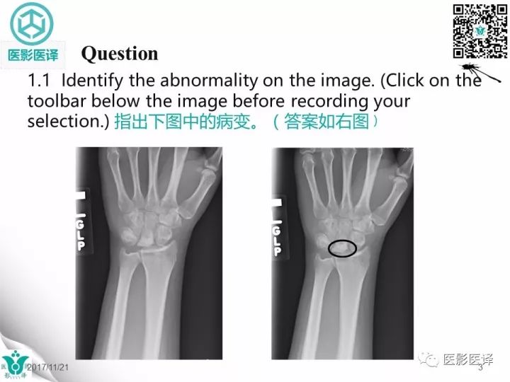 【病例】月骨缺血性坏死1例X线MR