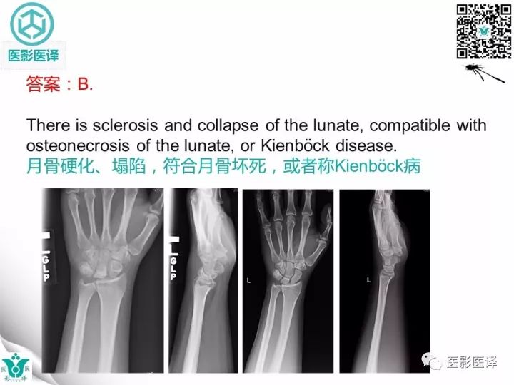 【病例】月骨缺血性坏死1例X线MR
