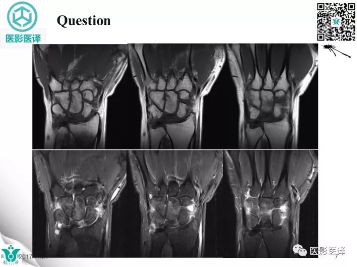 【病例】月骨缺血性坏死1例X线MR