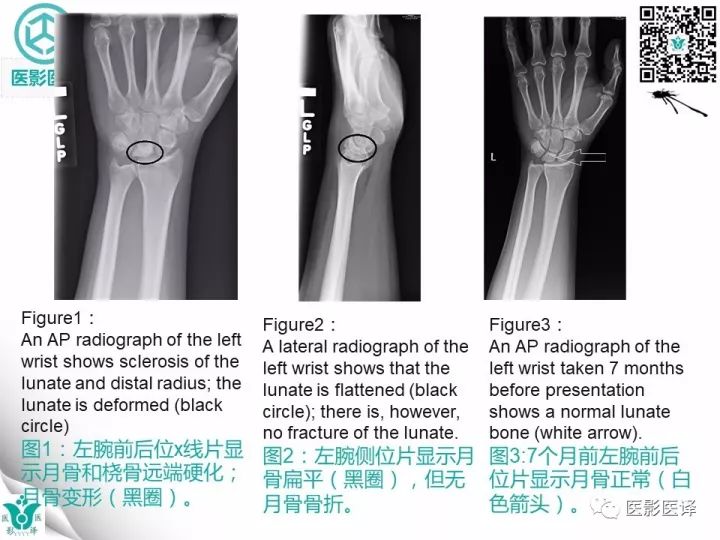 【病例】月骨缺血性坏死1例X线MR