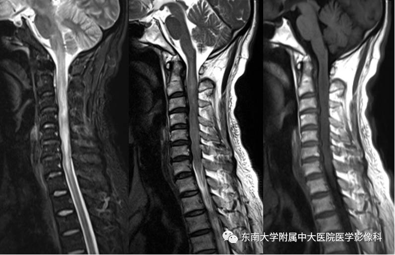 【病例】髓内星形胶质细胞瘤1例MR