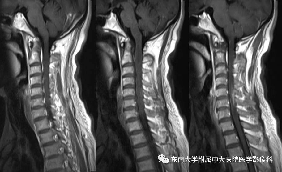 【病例】髓内星形胶质细胞瘤1例MR