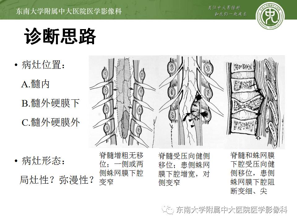 【病例】髓内星形胶质细胞瘤1例MR