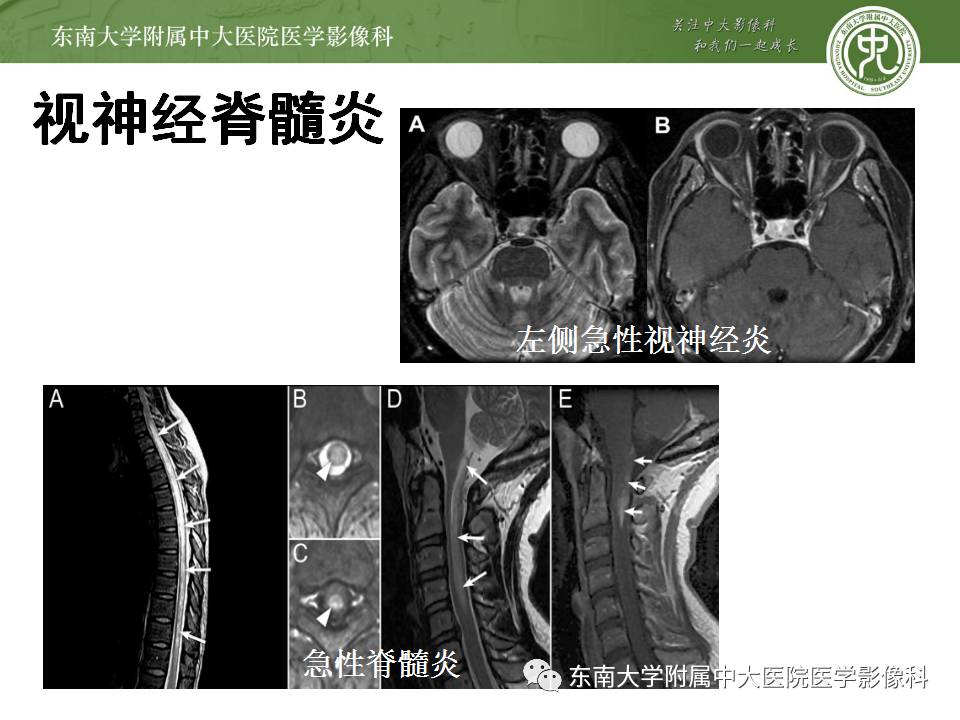 【病例】髓内星形胶质细胞瘤1例MR