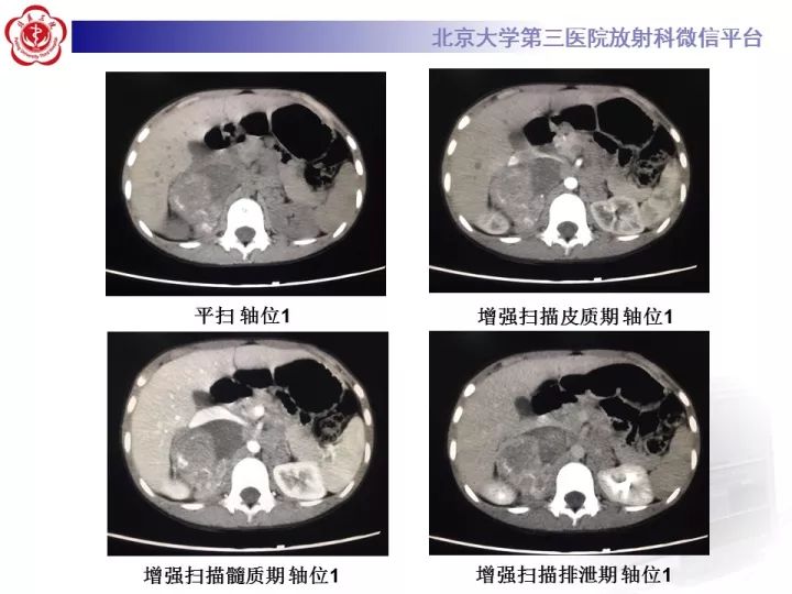 【病例】肾上腺神经母细胞瘤1例CT影像表现