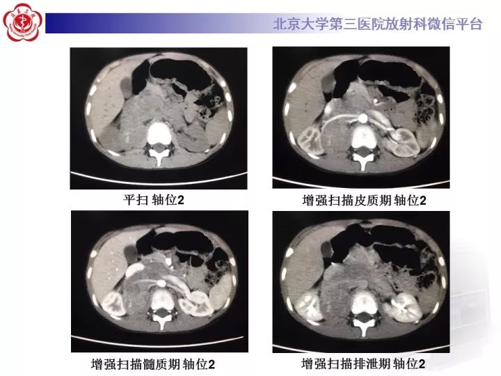 【病例】肾上腺神经母细胞瘤1例CT影像表现