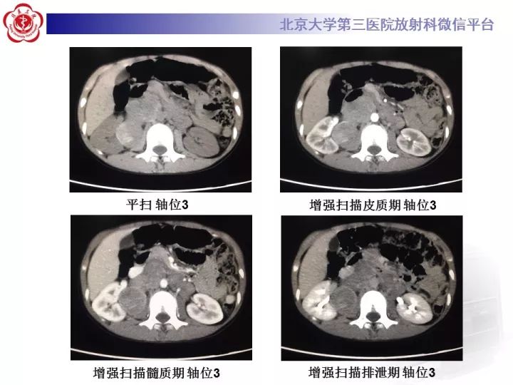 【病例】肾上腺神经母细胞瘤1例CT影像表现