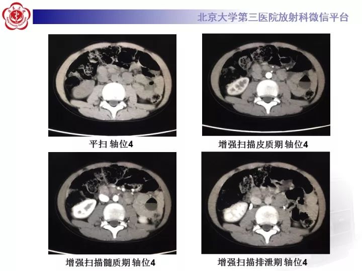 【病例】肾上腺神经母细胞瘤1例CT影像表现