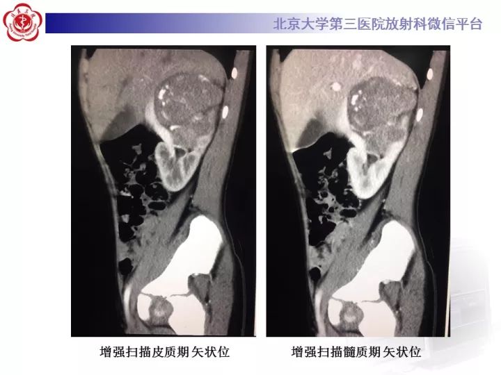 【病例】肾上腺神经母细胞瘤1例CT影像表现