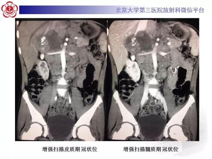 【病例】肾上腺神经母细胞瘤1例CT影像表现