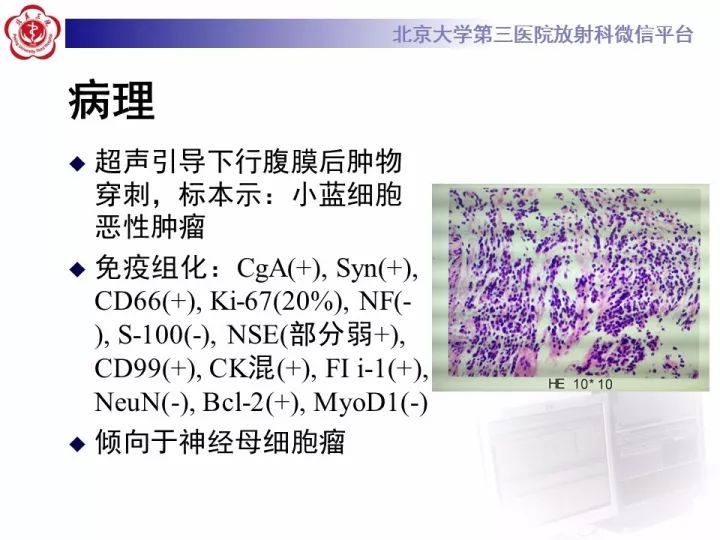 【病例】肾上腺神经母细胞瘤1例CT影像表现