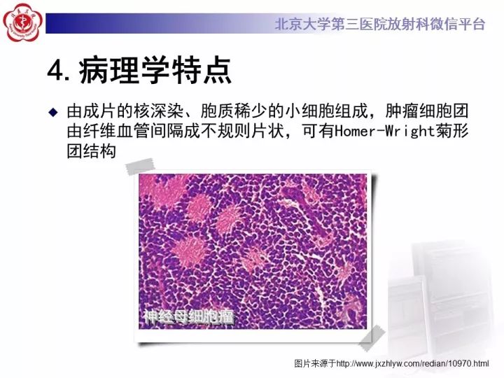 【病例】肾上腺神经母细胞瘤1例CT影像表现