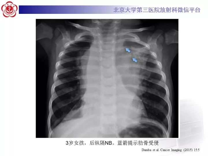 【病例】肾上腺神经母细胞瘤1例CT影像表现