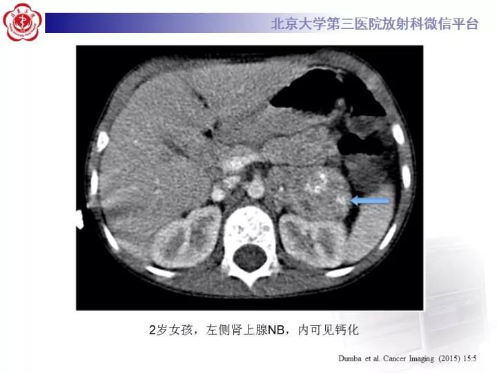 【病例】肾上腺神经母细胞瘤1例CT影像表现