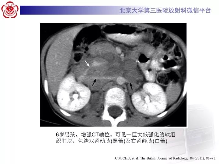 【病例】肾上腺神经母细胞瘤1例CT影像表现