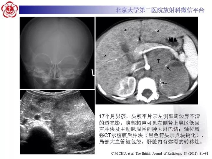 【病例】肾上腺神经母细胞瘤1例CT影像表现