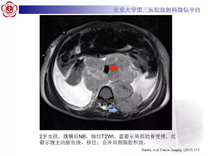 【病例】肾上腺神经母细胞瘤1例CT影像表现
