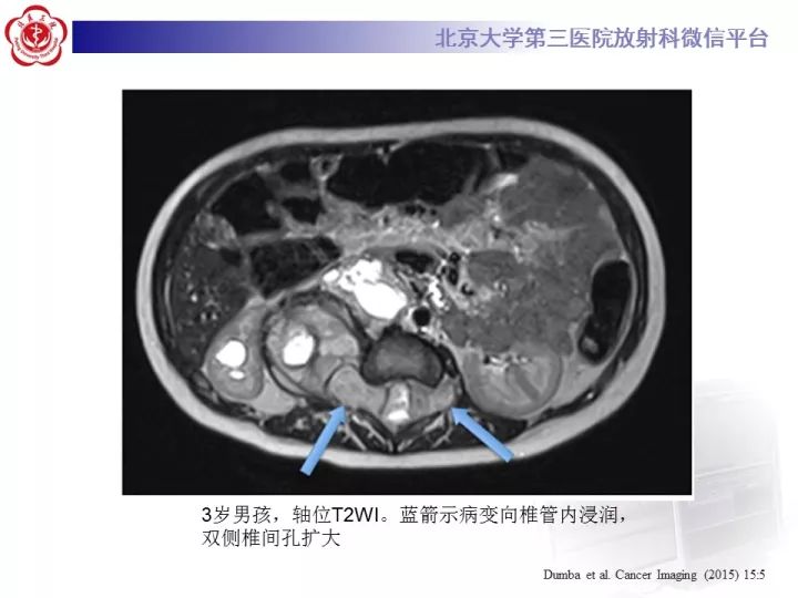 【病例】肾上腺神经母细胞瘤1例CT影像表现