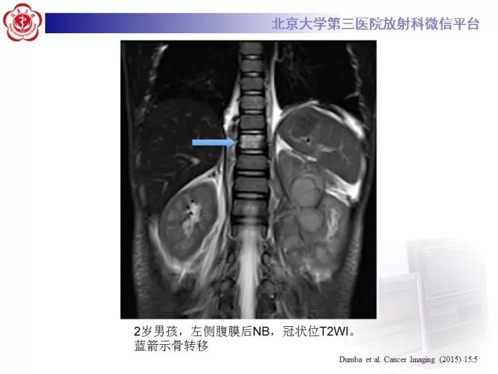【病例】肾上腺神经母细胞瘤1例CT影像表现