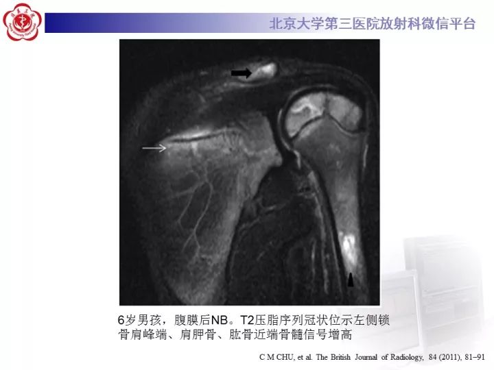 【病例】肾上腺神经母细胞瘤1例CT影像表现