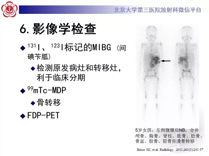【病例】肾上腺神经母细胞瘤1例CT影像表现
