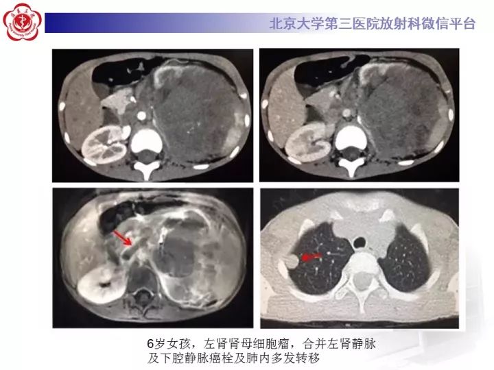 【病例】肾上腺神经母细胞瘤1例CT影像表现