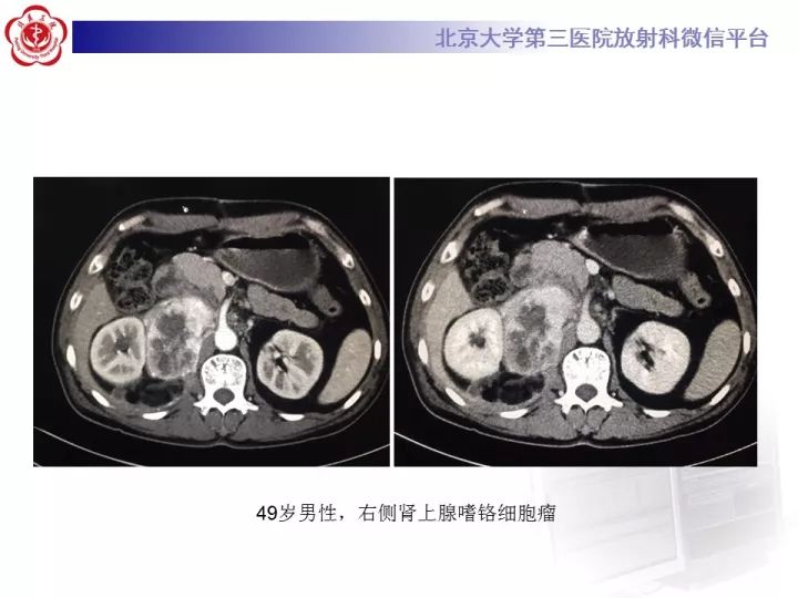 【病例】肾上腺神经母细胞瘤1例CT影像表现