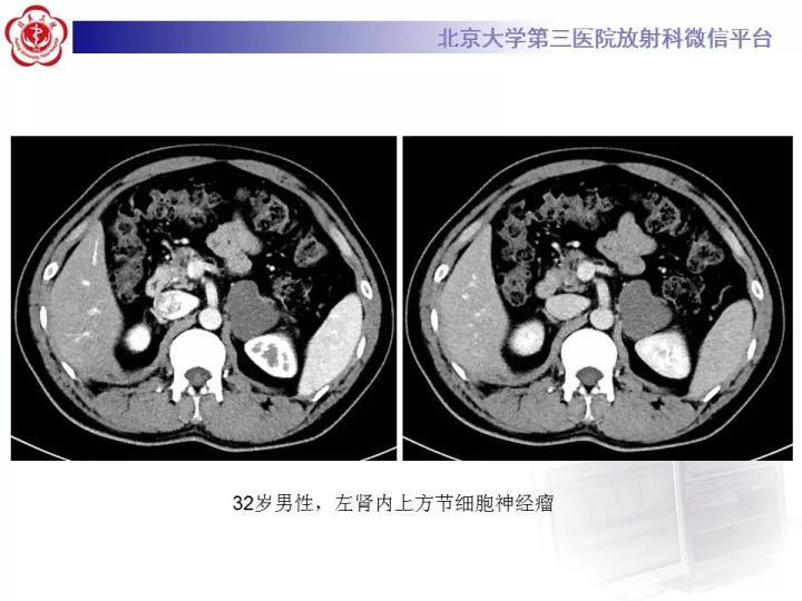 【病例】肾上腺神经母细胞瘤1例CT影像表现