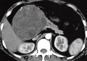 【病例】胰腺实性假乳头状瘤1例CT影像表现 【病例】胰腺实性假乳头状瘤1例CT影像表现