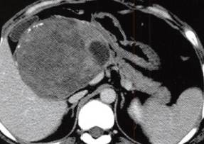 【病例】胰腺实性假乳头状瘤1例CT影像表现 【病例】胰腺实性假乳头状瘤1例CT影像表现