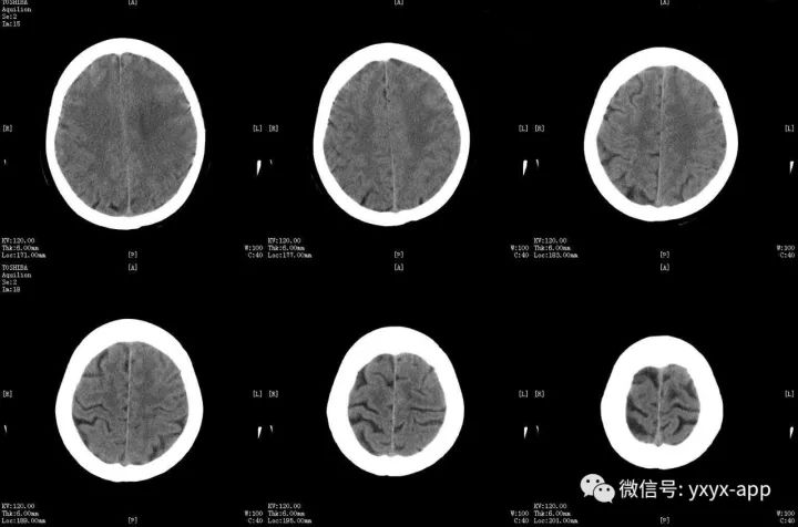 【病例】脑脓肿1例CT及MR影像表现 【病例】脑脓肿1例CT及MR影像表现
