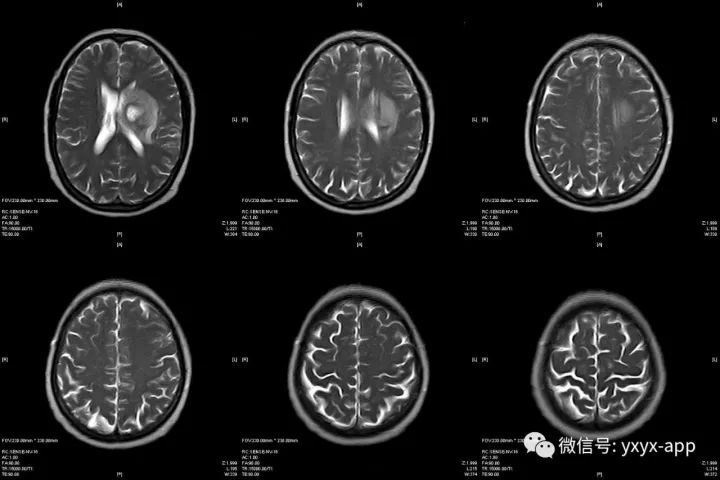【病例】脑脓肿1例CT及MR影像表现 【病例】脑脓肿1例CT及MR影像表现