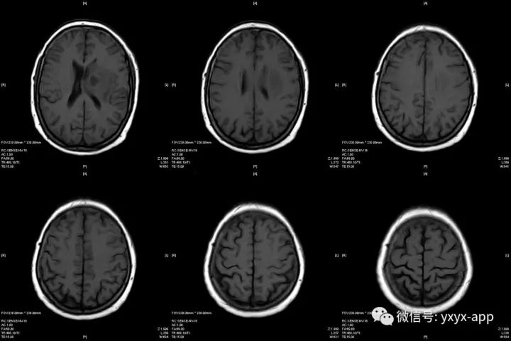 【病例】脑脓肿1例CT及MR影像表现 【病例】脑脓肿1例CT及MR影像表现