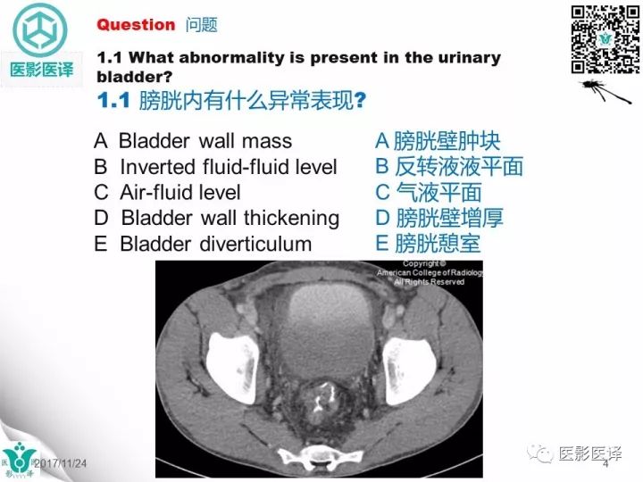 【病例】膀胱反转液平—尿液与对比剂液平反转1例CT