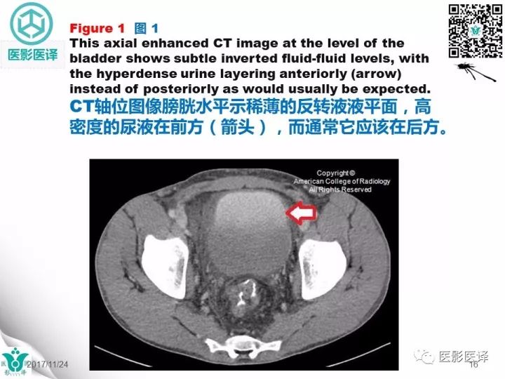 【病例】膀胱反转液平—尿液与对比剂液平反转1例CT