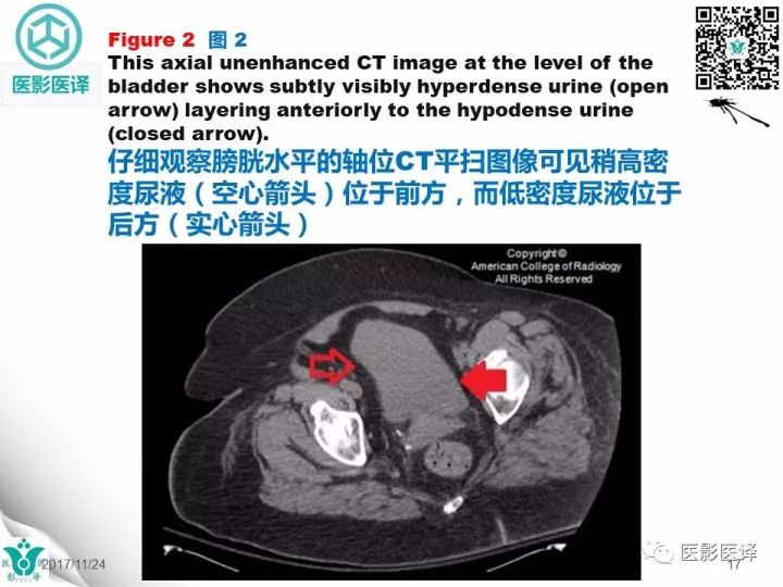 【病例】膀胱反转液平—尿液与对比剂液平反转1例CT