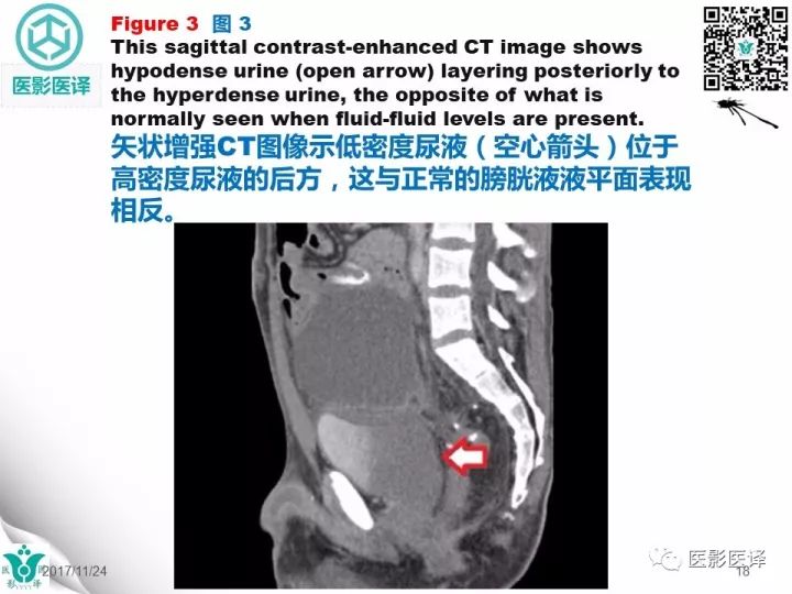 【病例】膀胱反转液平—尿液与对比剂液平反转1例CT