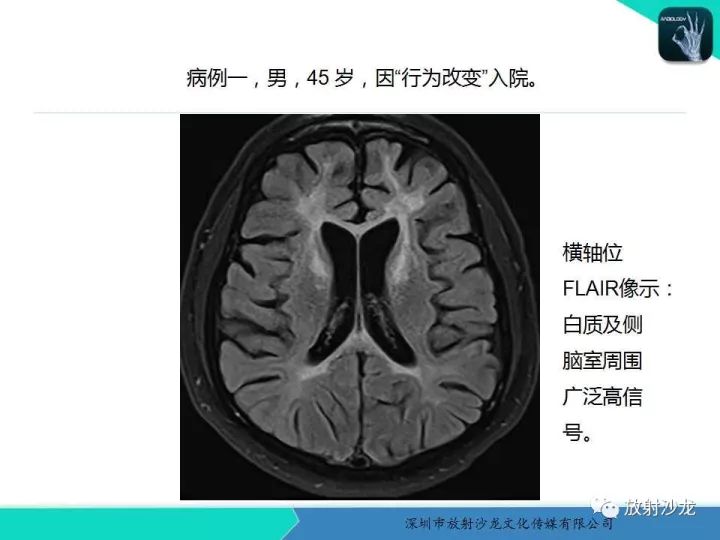 【PPT】肾上腺脑白质营养不良