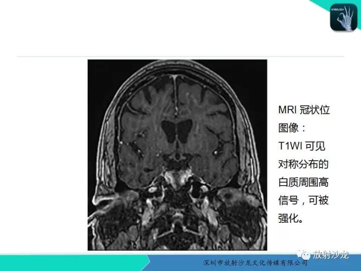 【PPT】肾上腺脑白质营养不良