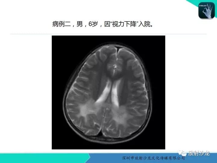 【PPT】肾上腺脑白质营养不良