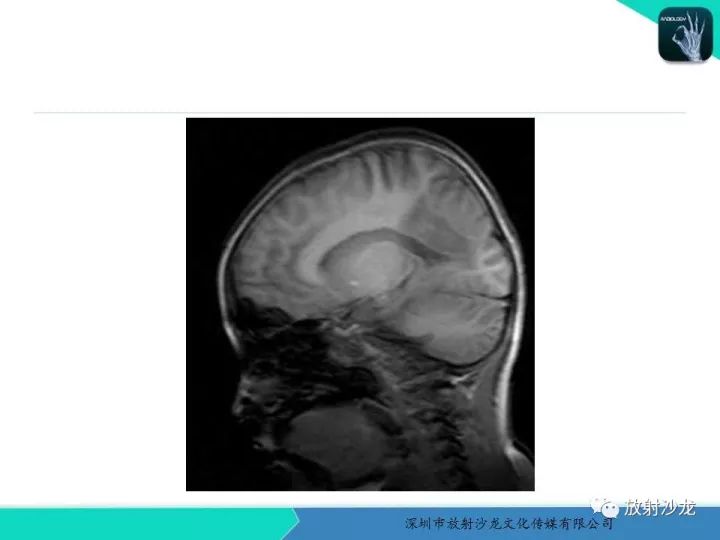 【PPT】肾上腺脑白质营养不良