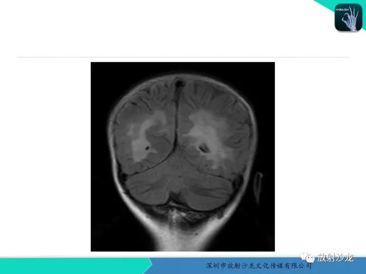 【PPT】肾上腺脑白质营养不良