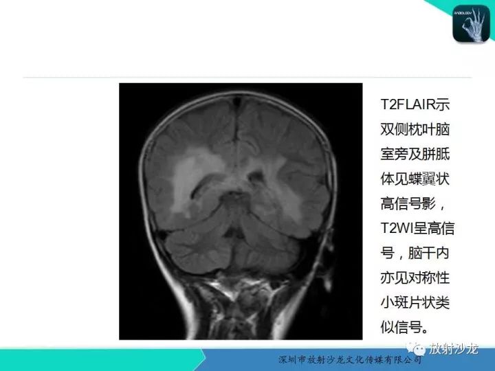 【PPT】肾上腺脑白质营养不良