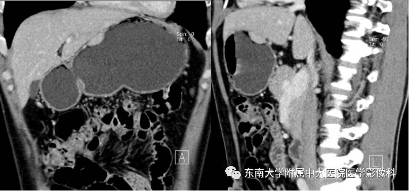【病例】胃部异位胰腺1例CT影像表现