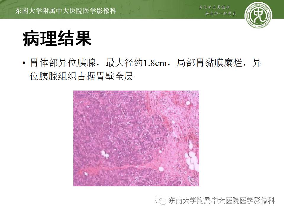 【病例】胃部异位胰腺1例CT影像表现