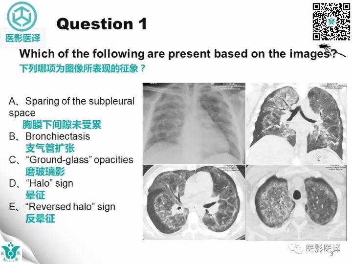 【病例】肺孢子菌肺炎1例CT影像表现
