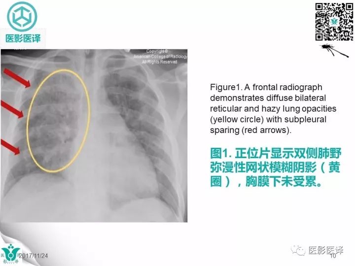 【病例】肺孢子菌肺炎1例CT影像表现