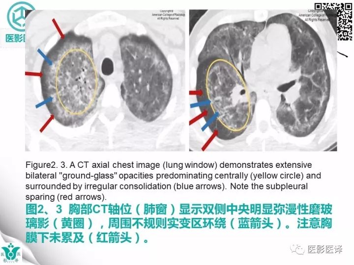 【病例】肺孢子菌肺炎1例CT影像表现