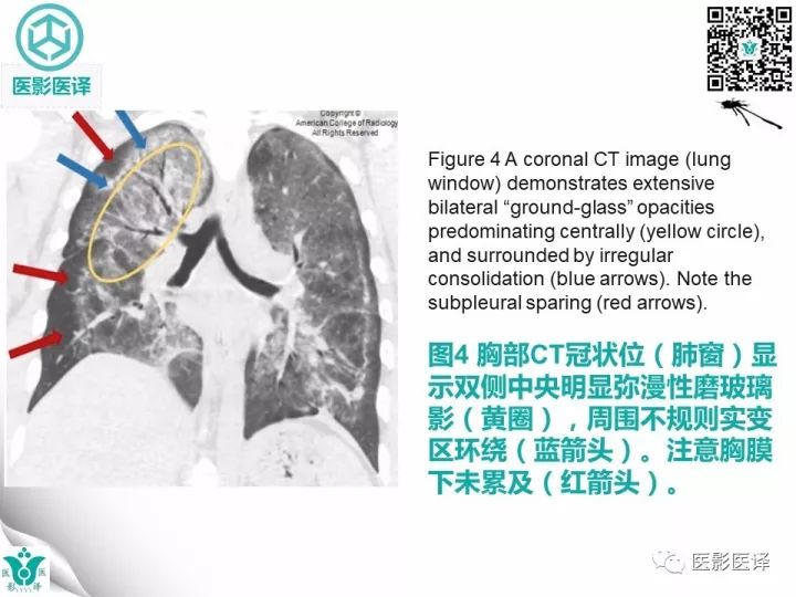 【病例】肺孢子菌肺炎1例CT影像表现