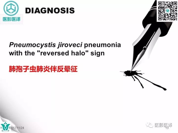 【病例】肺孢子菌肺炎1例CT影像表现